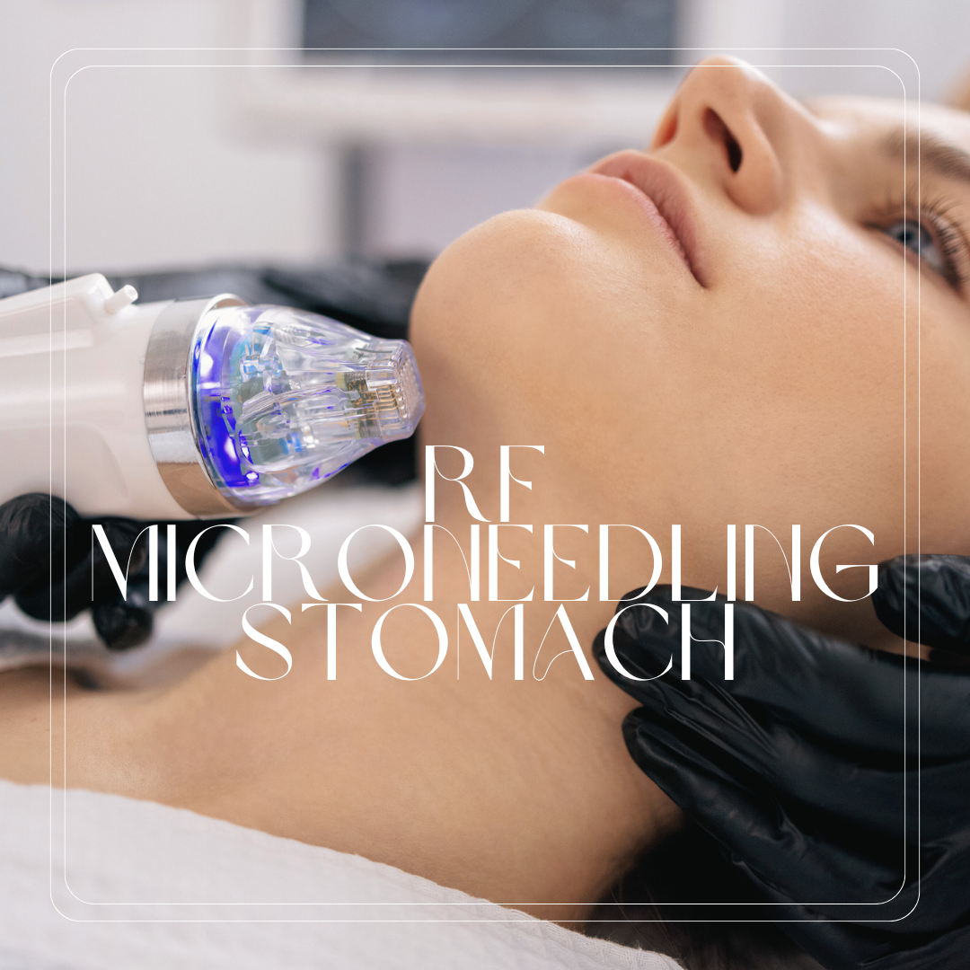 RF Microneedling - Stomach