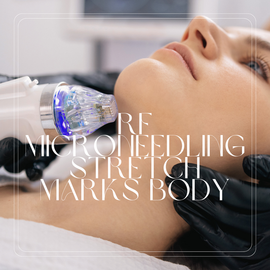 RF Microneedling - Stretch Marks on Body